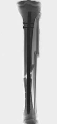 Tibia & Fibula Fraktur